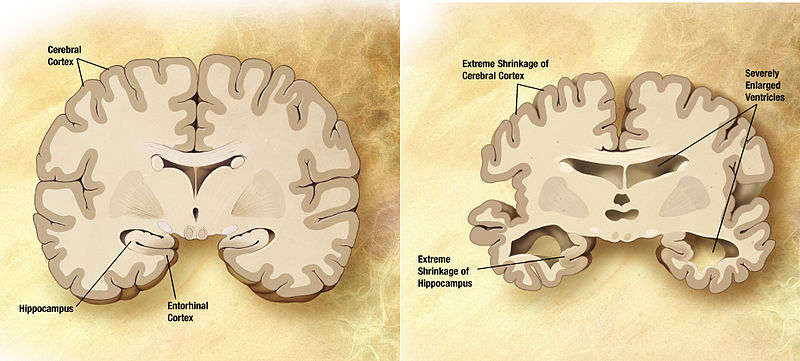 Ilustracja przedstawia uszkodzenia mózgu wywołane chorobą Alzheimera. (Credit: Wikipedia)